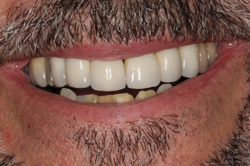 Porcelain veneers After 3