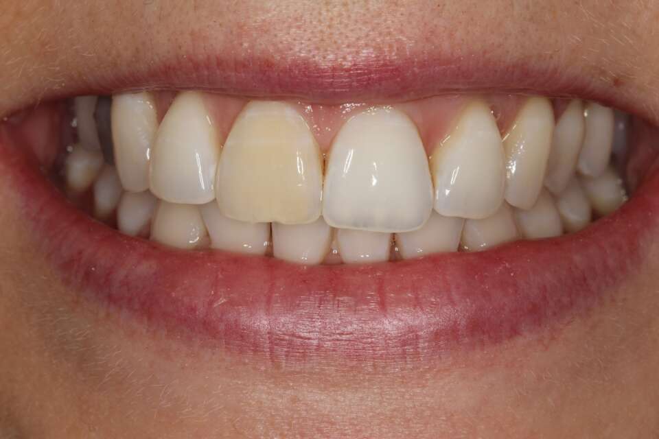 Porcelain veneers Before 4