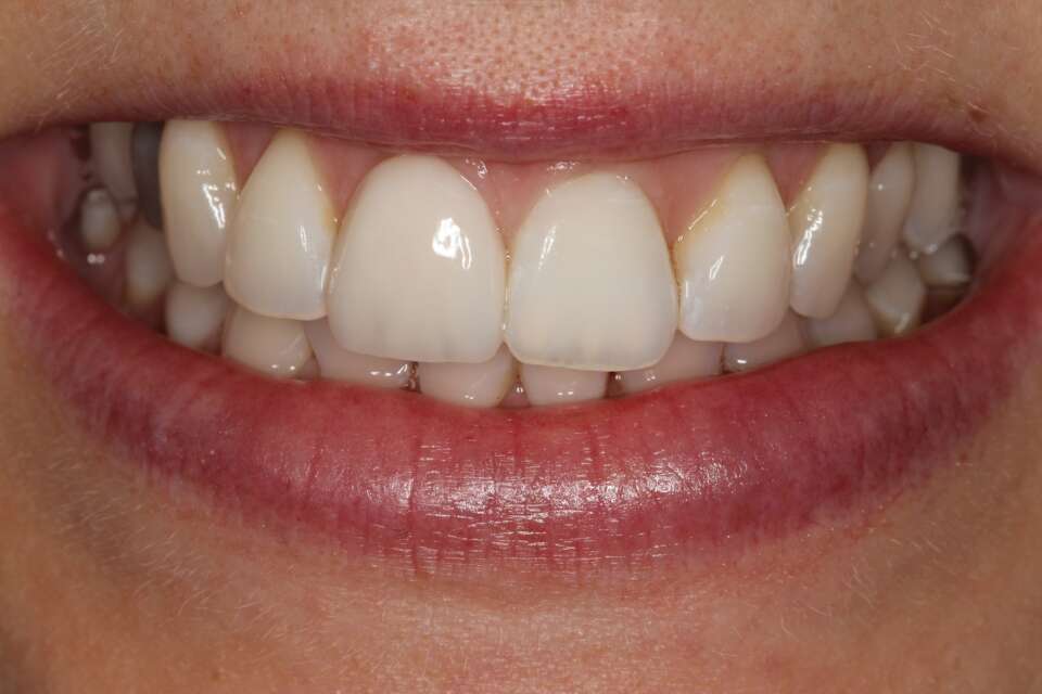 Porcelain veneers After 4