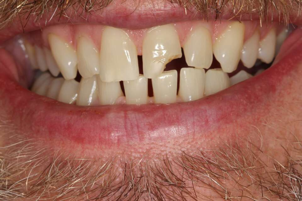 Porcelain veneers Before 5