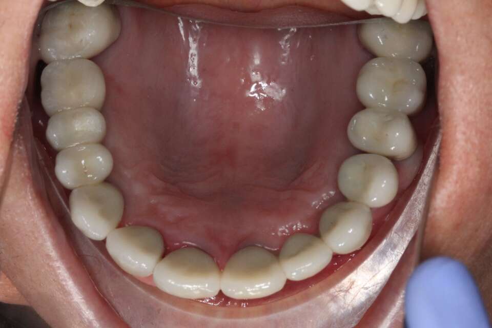 Several teeth implants After 5