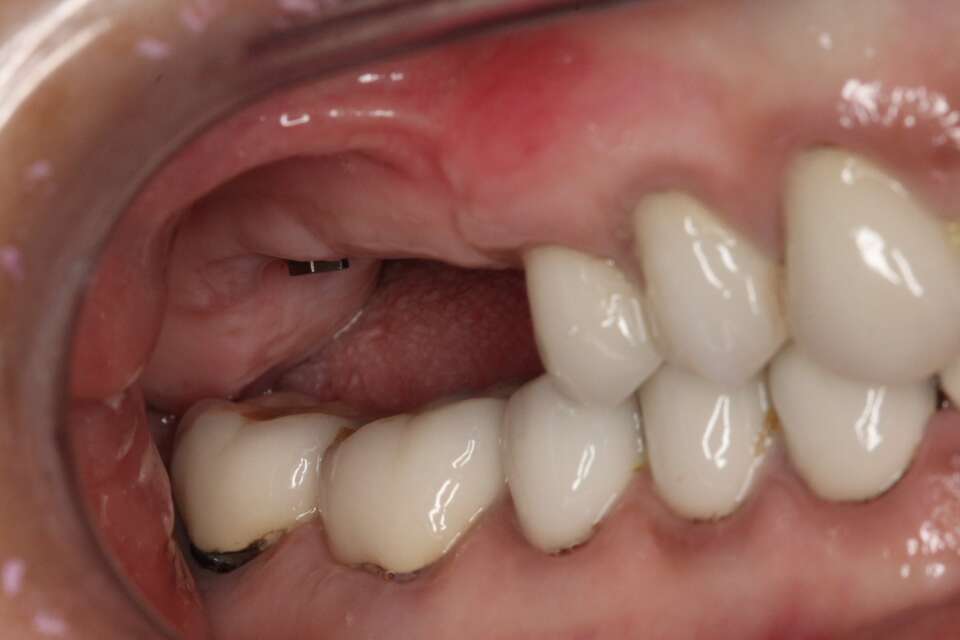 Several teeth implants Before 1