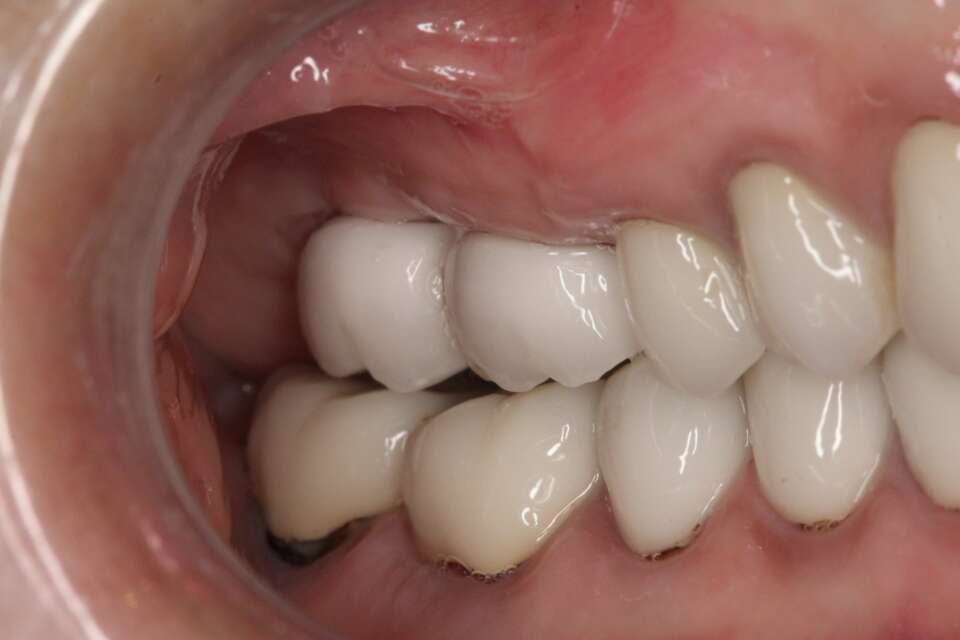 Several teeth implants After 1