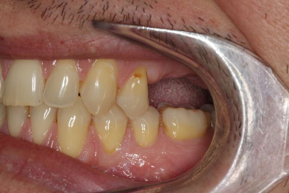 Several teeth implants Before 2