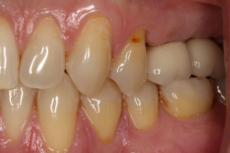 Several teeth implants After 2