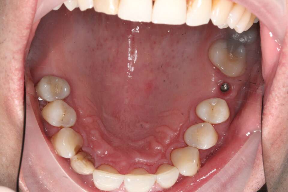 Several teeth implants Before 3
