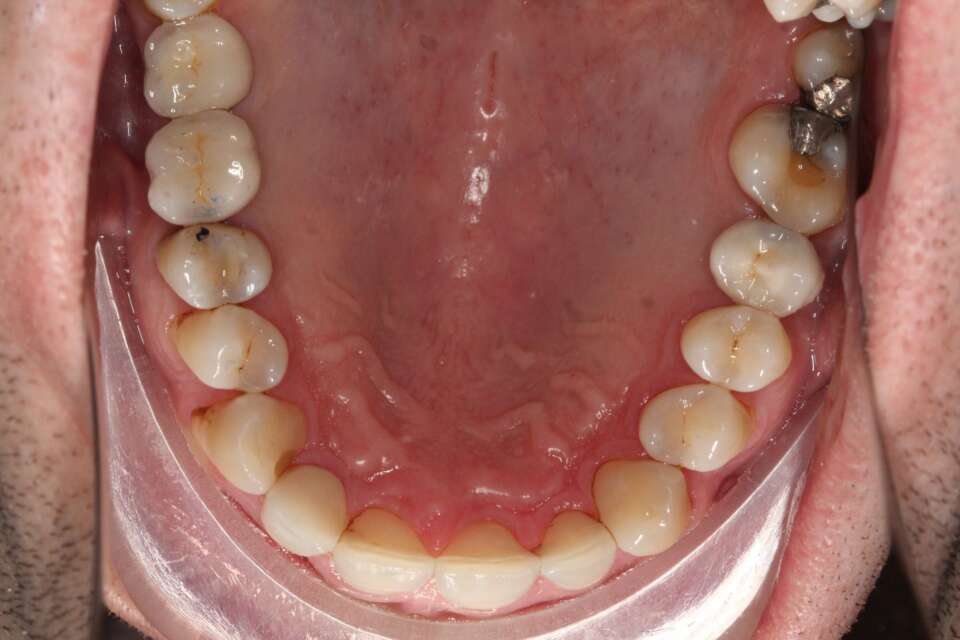 Several teeth implants After 3