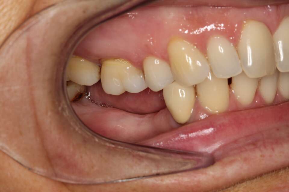 Several teeth implants Before 4
