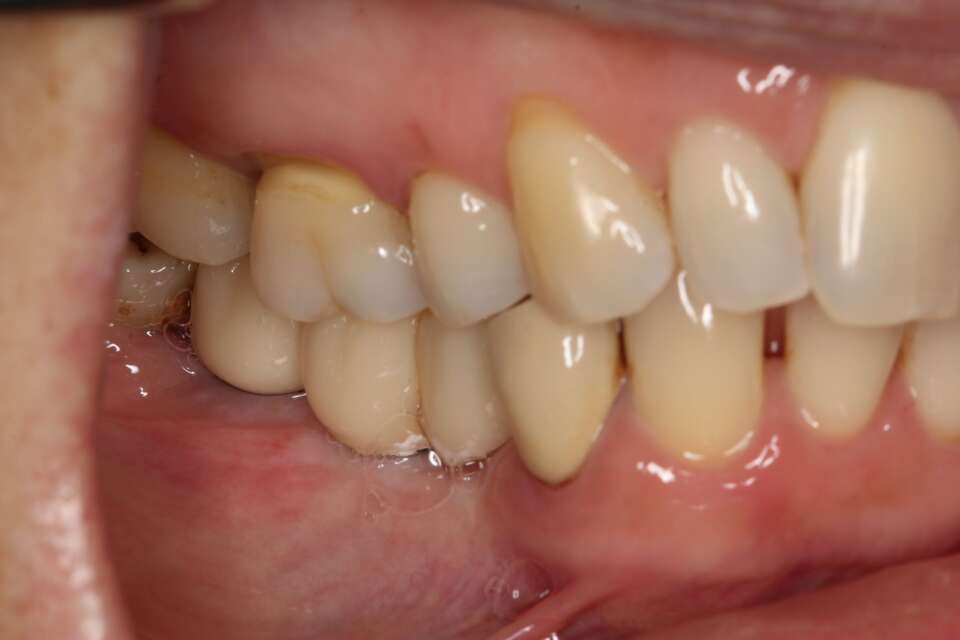 Several teeth implants After 4