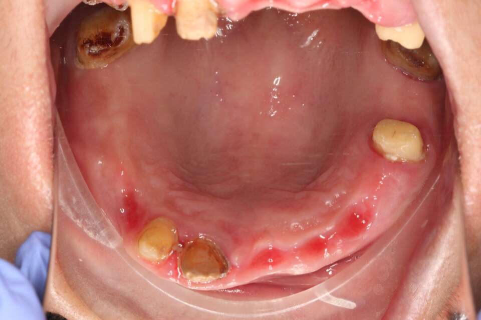 Several teeth implants Before 5