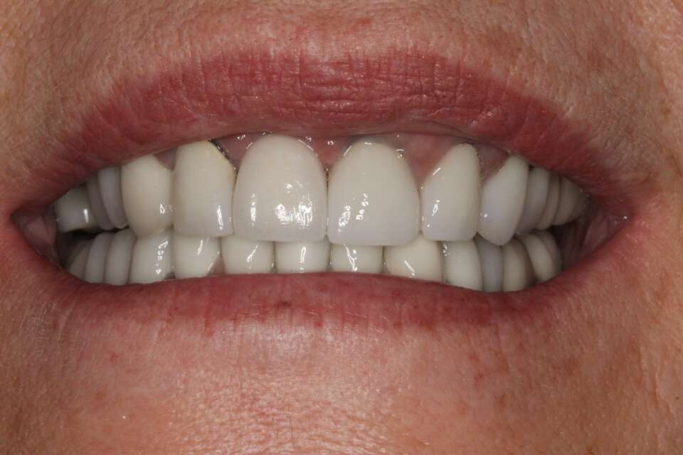 Single tooth implant After 5