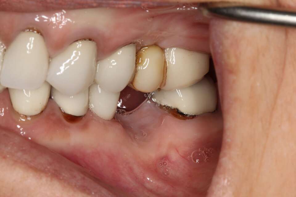 Single tooth implant Before 6