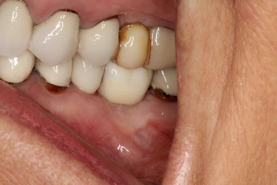 Single tooth implant After 6