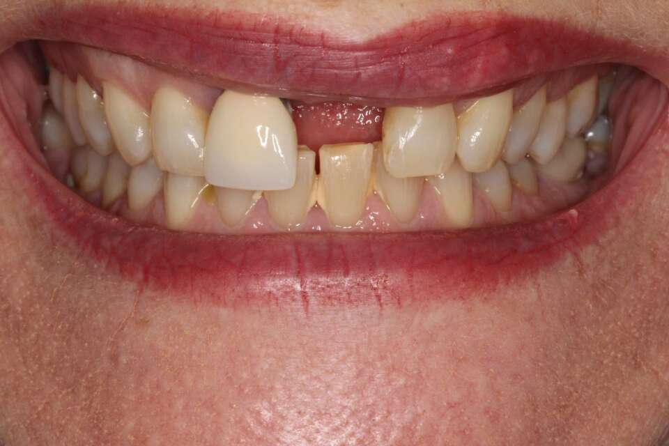Single tooth implant Before 7