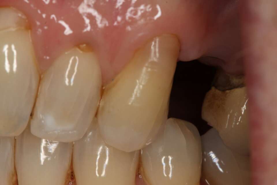 Single tooth implant Before 1