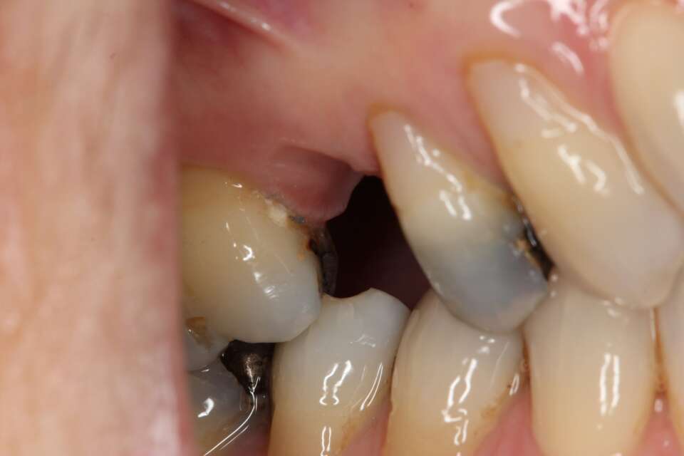 Single tooth implant Before 2