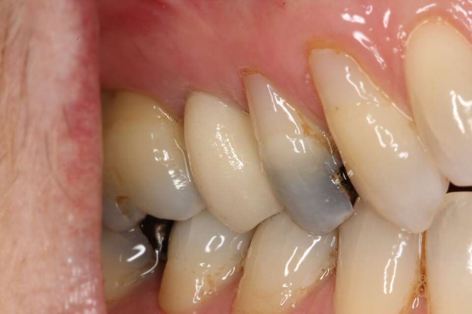 Single tooth implant After 2