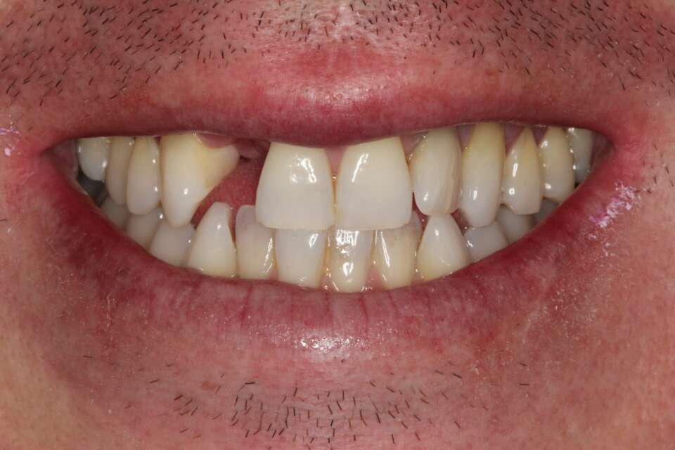 Single tooth implant Before 3
