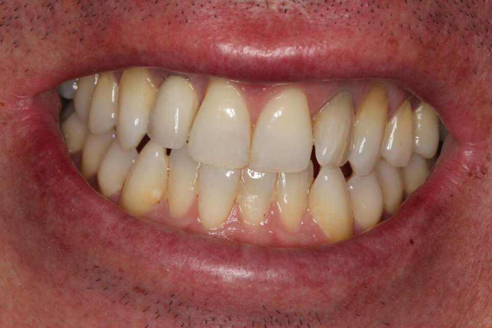 Single tooth implant After 3