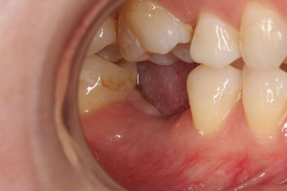 Single tooth implant Before 4