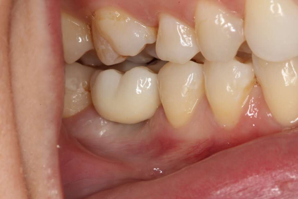 Single tooth implant After 4