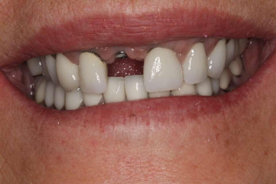Single tooth implant Before 5