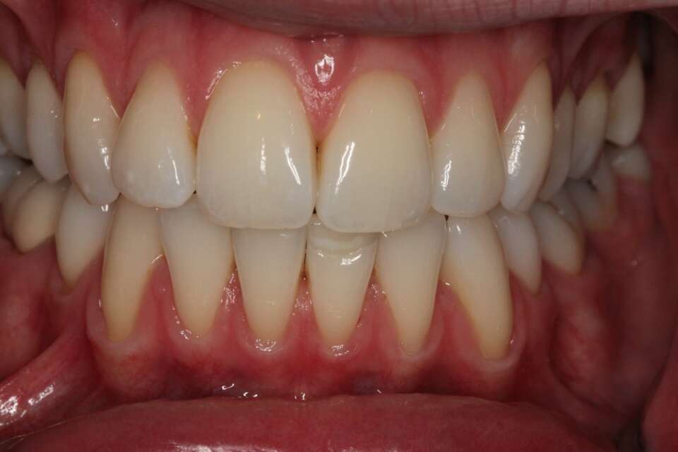 Tooth whitening After 2