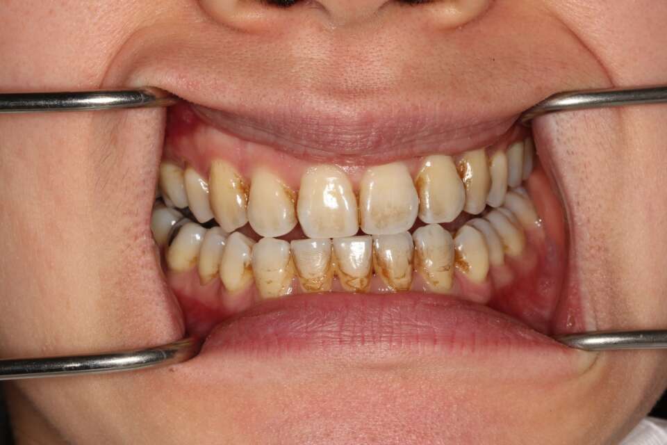 Tooth whitening Before 4