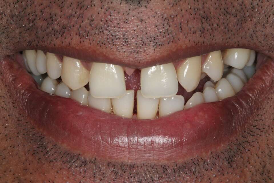Crowns Before 4