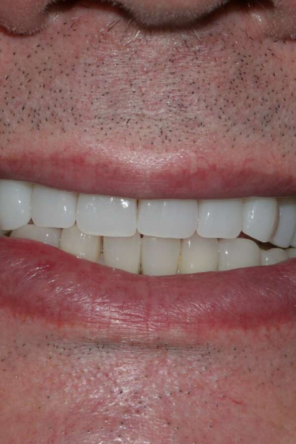 All teeth implants After 5