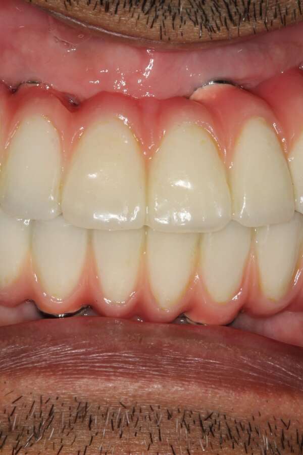 All teeth implants After 1