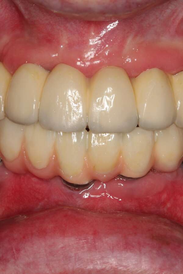 All teeth implants After 2