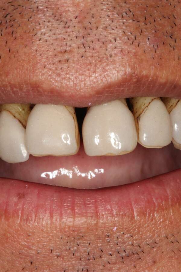 All teeth implants Before 4