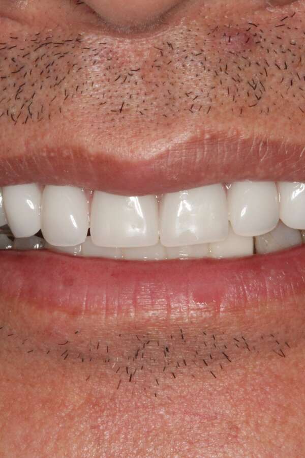 All teeth implants After 4