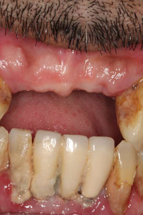 All teeth implants Before 1