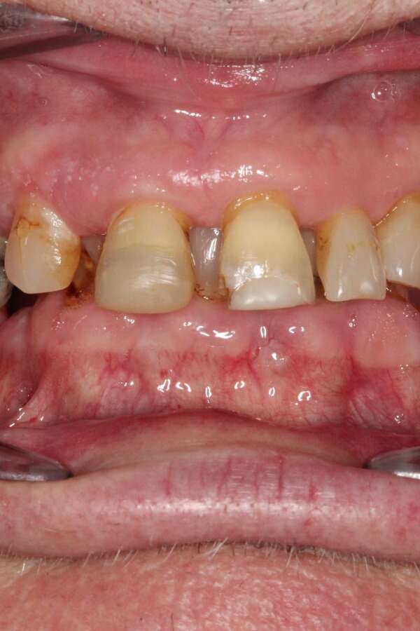 All teeth implants Before 2