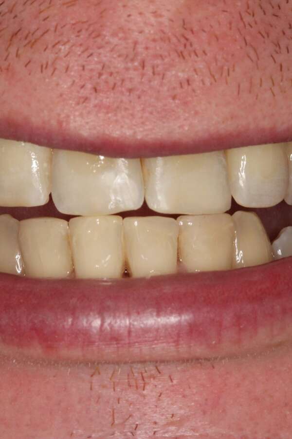 Cosmetic bonding After 8