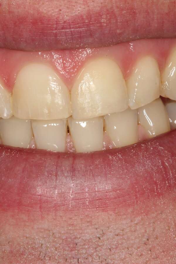 Cosmetic bonding Before 2