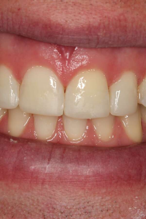 Cosmetic bonding After 2