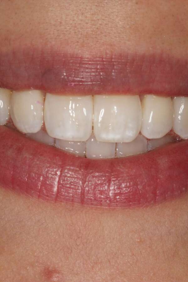 after Invisalign rotated teeth striaghtened