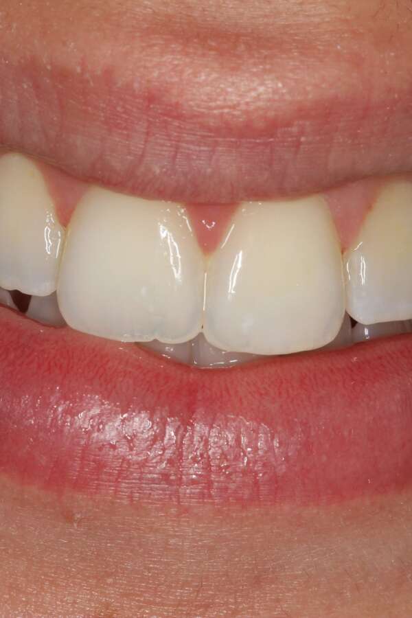 after Invisalign treatment straight teeth