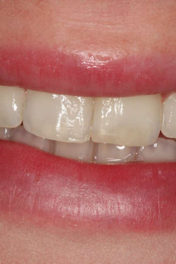 Invisalign After 3