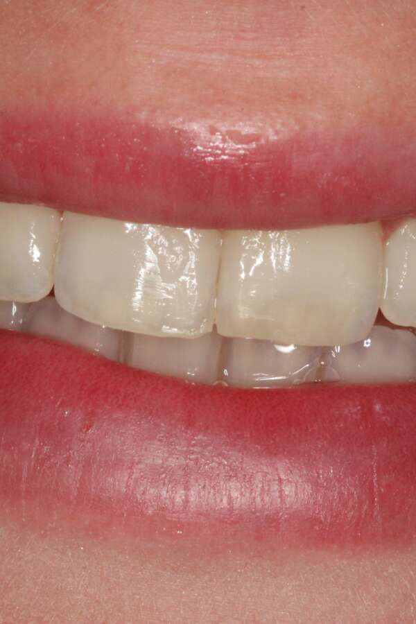 after Invisalign treatment straightened rotated teeth