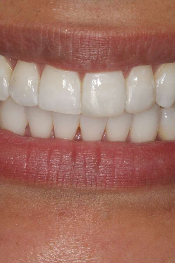 after Invisalign treatment incisor straightened