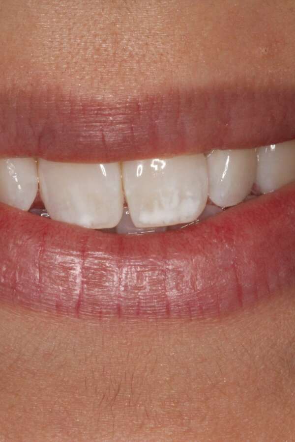 before Invisalign treatment slightly rotated teeth