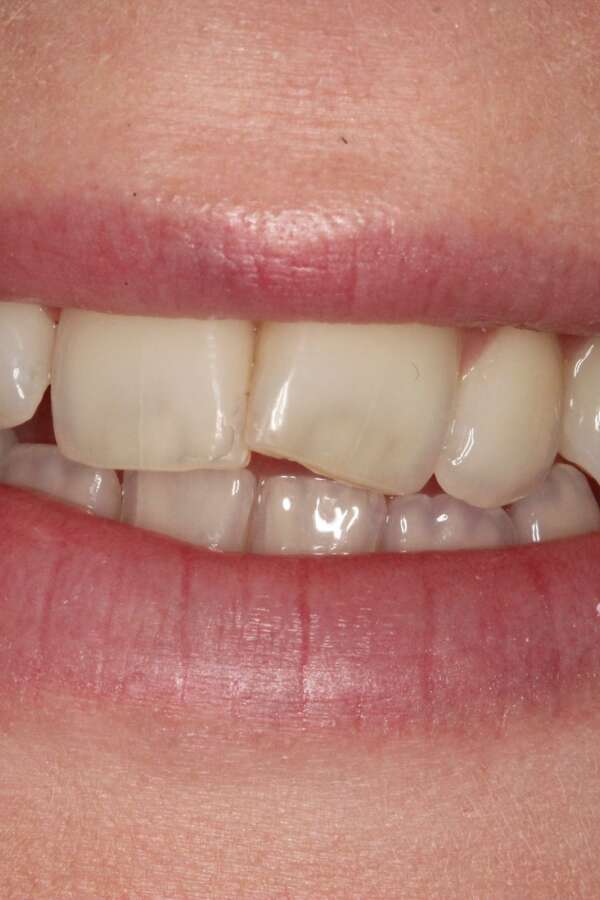 before Invisalign treatment teeth rotated