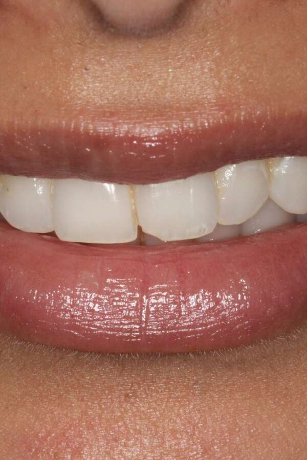 before Invisalign treatment left incisor chipped