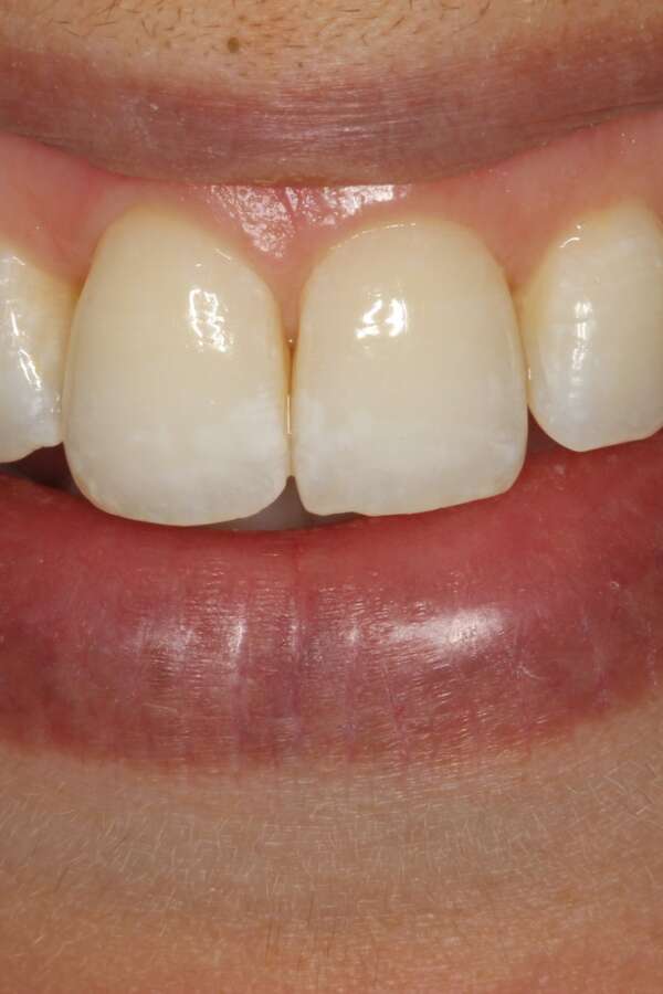 Lingual Braces After 1