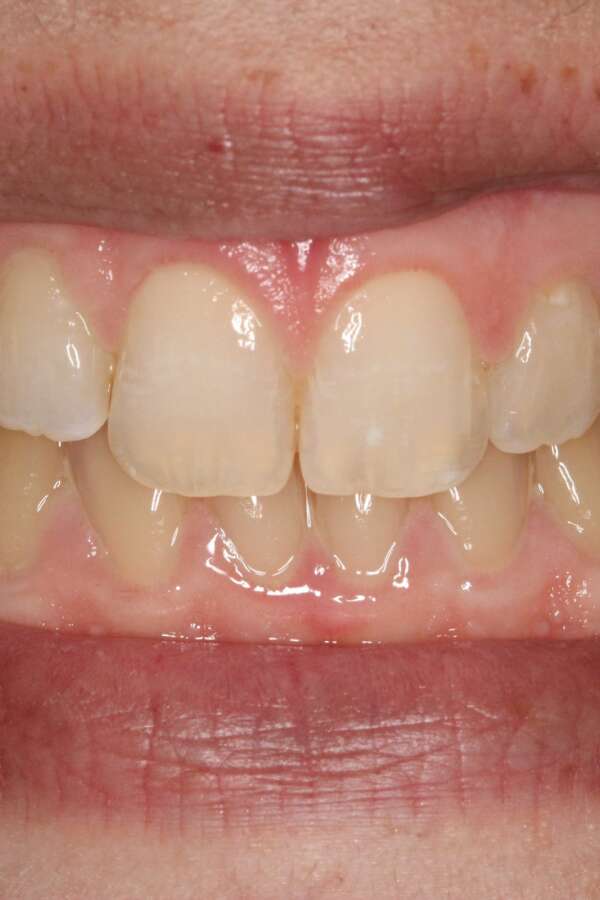 Lingual Braces After 2