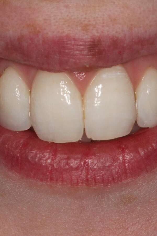 Lingual Braces After 4